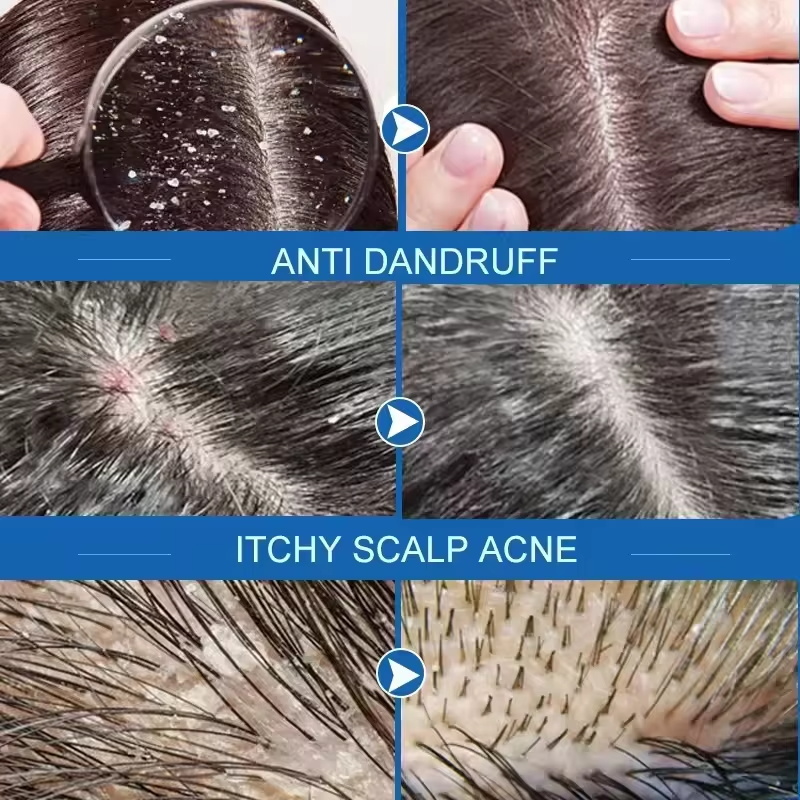 Fast Anti Dandruff Hair Treatm - Hair Care Dandruff のレビューと価格