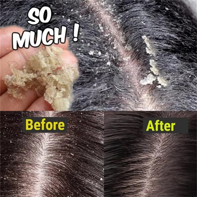 Fast Anti Dandruff Hair Treatm - Hair Care Dandruff のレビューと価格